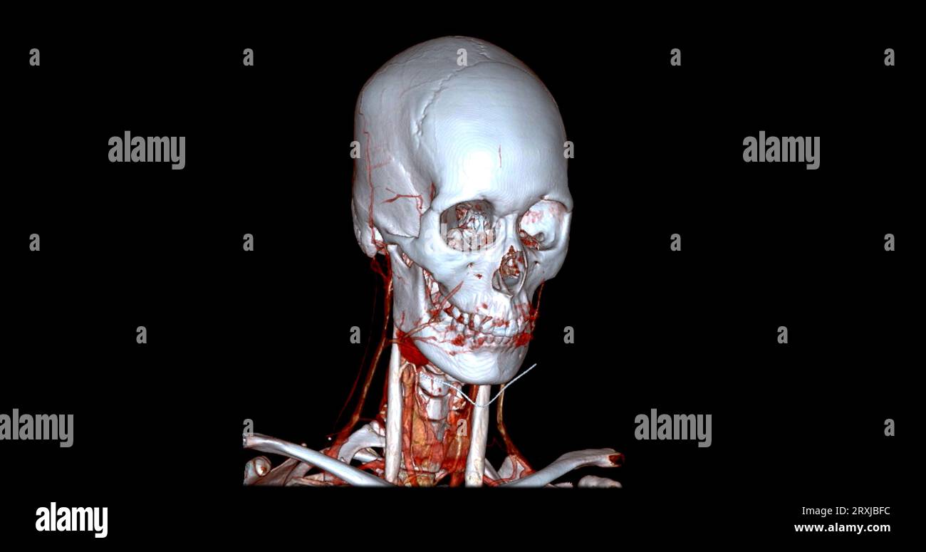Angiographie TDM du cerveau ou angiographie angiographique du cerveau et du cou vue sagittale 3D mode de fusion d'images . concept de technologie médicale. Banque D'Images