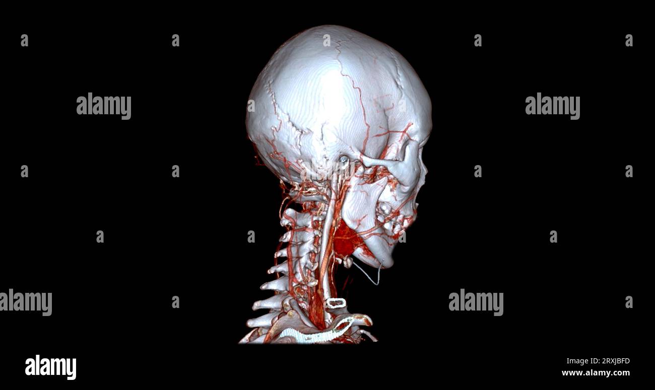 Angiographie TDM du cerveau ou angiographie angiographique du cerveau et du cou vue sagittale 3D mode de fusion d'images . concept de technologie médicale. Banque D'Images