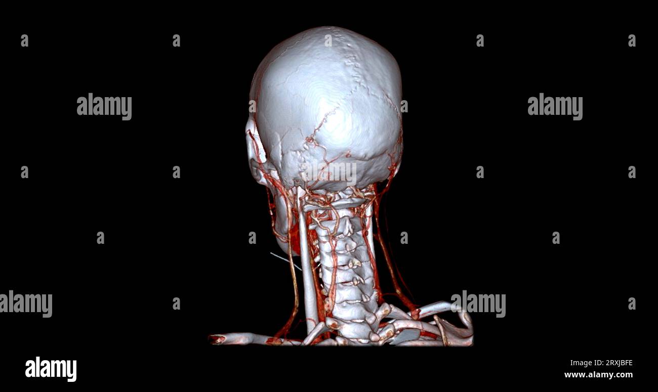 Angiographie TDM du cerveau ou angiographie angiographique du cerveau et du cou vue sagittale 3D mode de fusion d'images . concept de technologie médicale. Banque D'Images