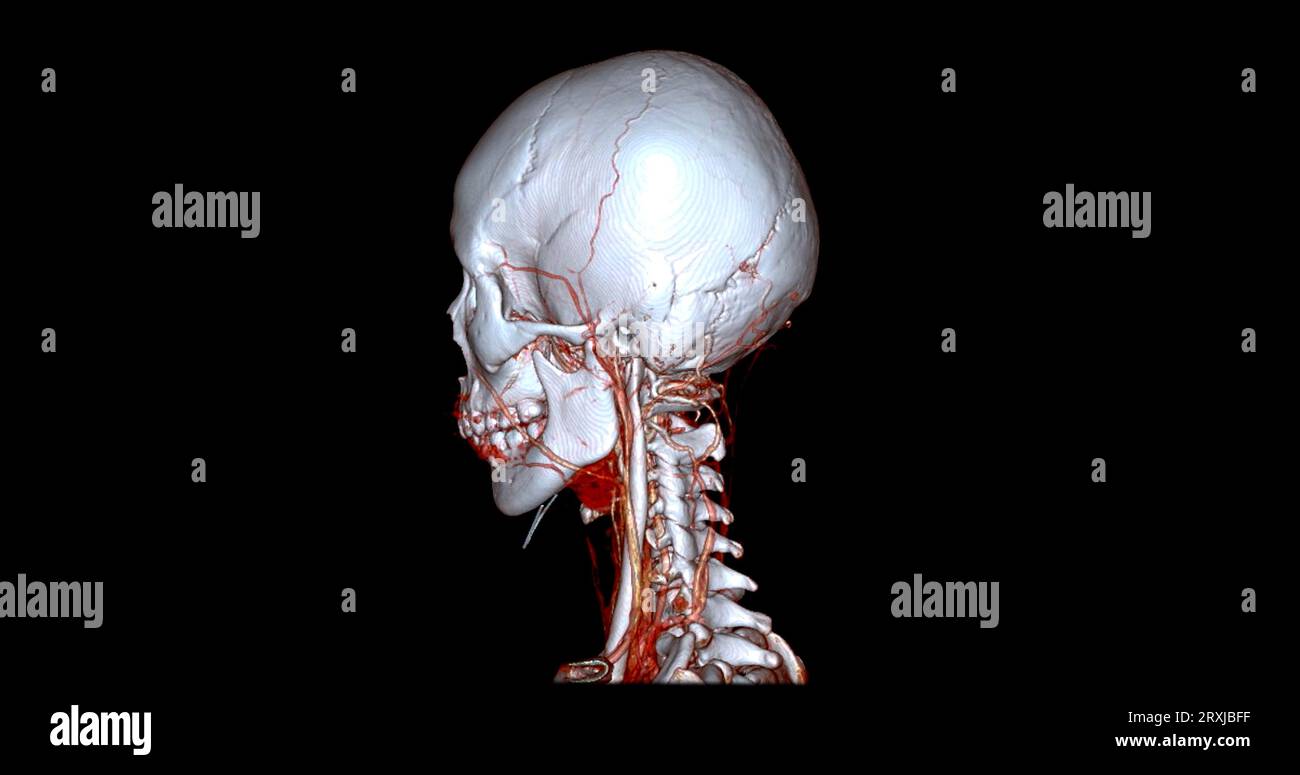 Angiographie TDM du cerveau ou angiographie angiographique du cerveau et du cou vue sagittale 3D mode de fusion d'images . concept de technologie médicale. Banque D'Images