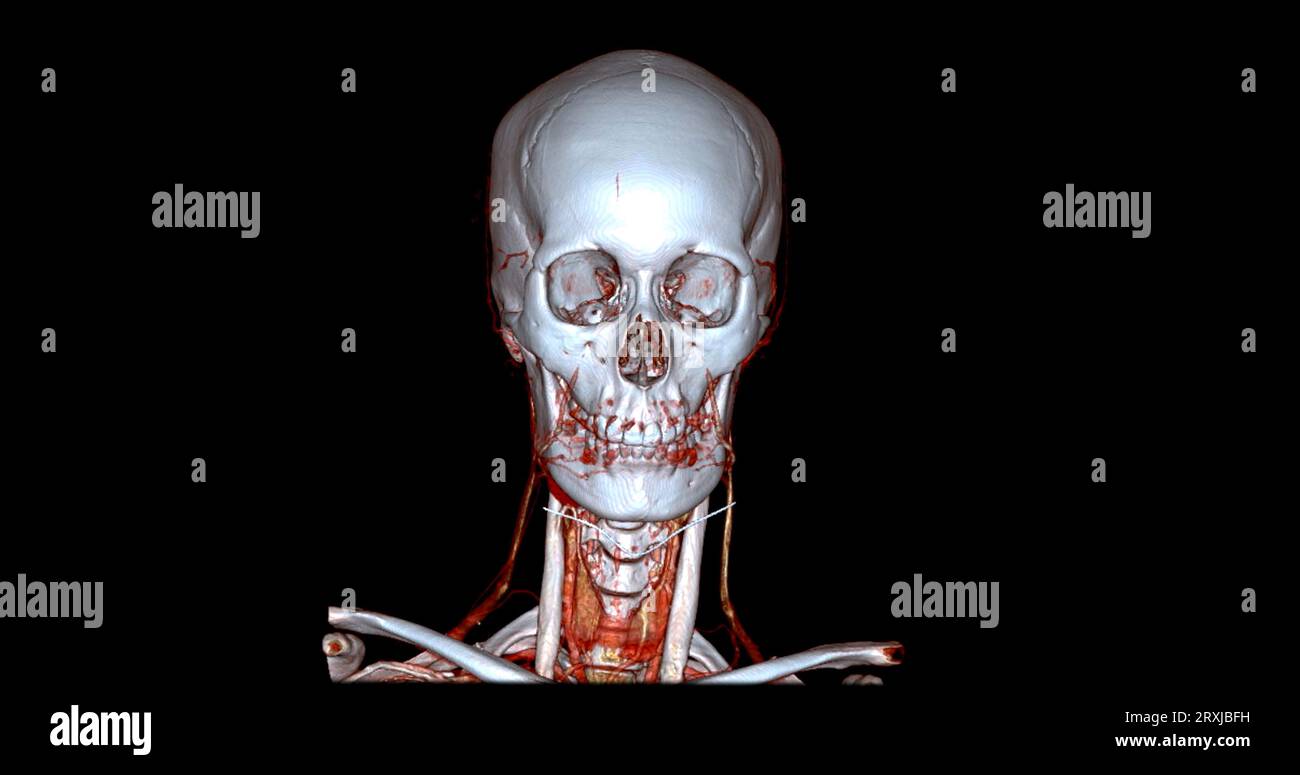 Angiographie TDM du cerveau ou angiographie angiographique du cerveau et du cou vue sagittale 3D mode de fusion d'images . concept de technologie médicale. Banque D'Images
