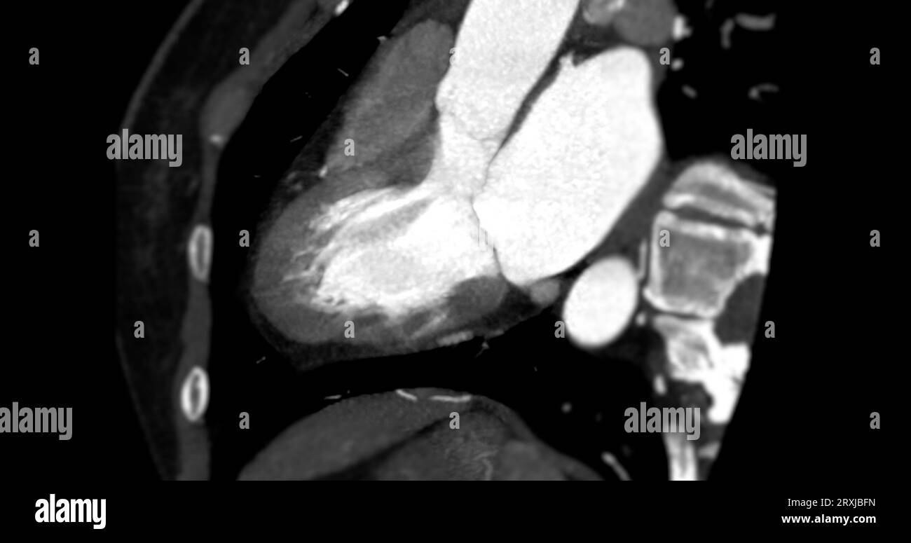 Angiographie coronaire vue verticale grand axe pour le diagnostic de sténose de l'artère coronaire vasculaire. Banque D'Images