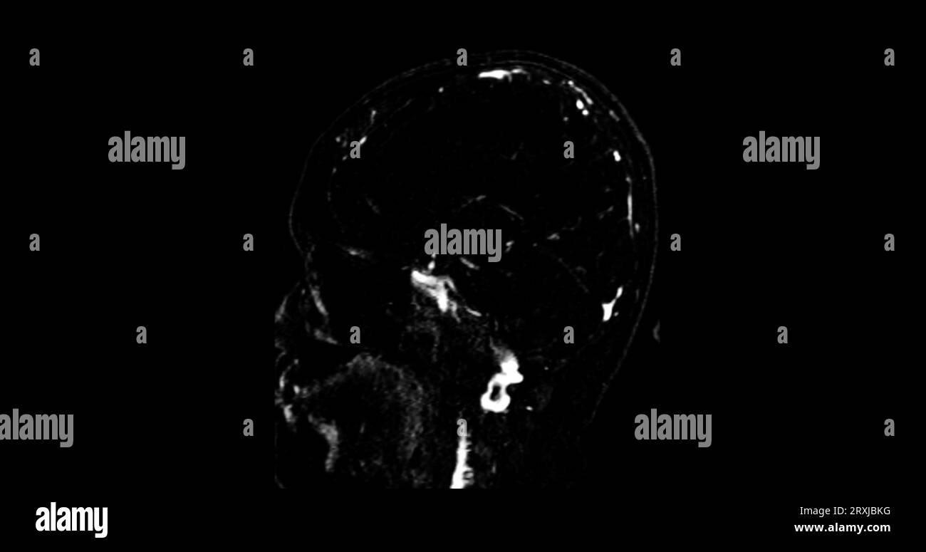 MRV cerveau ou veinographie par résonance magnétique du cerveau pour le diagnostic des anomalies dans le drainage veineux du cerveau Banque D'Images