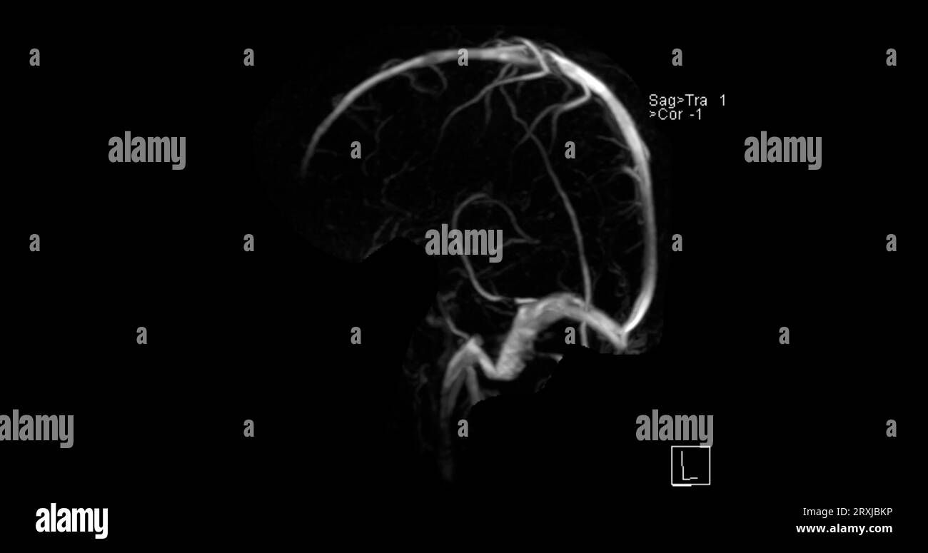 MRV cerveau ou veinographie par résonance magnétique du cerveau pour le diagnostic des anomalies dans le drainage veineux du cerveau Banque D'Images