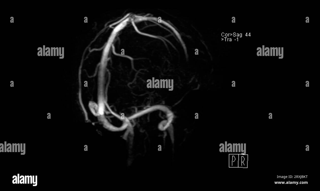 MRV cerveau ou veinographie par résonance magnétique du cerveau pour le diagnostic des anomalies dans le drainage veineux du cerveau Banque D'Images
