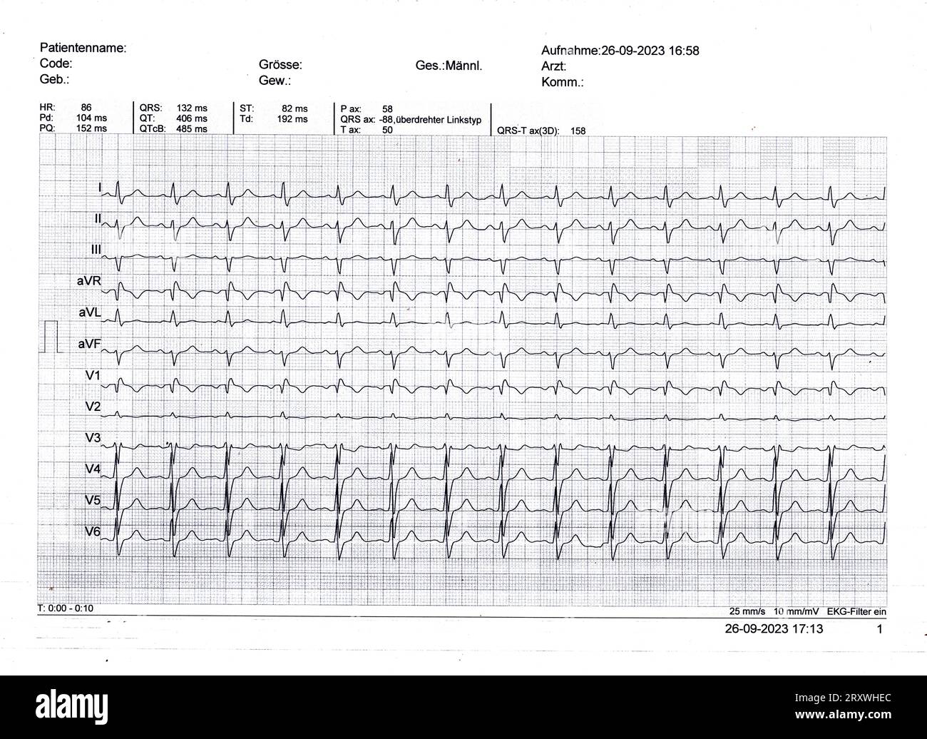 DATE D'ENREGISTREMENT NON INDIQUÉE Abbild eines EKG Ein Elektrokardiogramm EKG von einem 61-jährigen Mann zur Kontrolle der Herzfunktion *** image d'un ECG un électrocardiogramme ECG d'un homme de 61 ans pour vérifier la fonction cardiaque. Banque D'Images