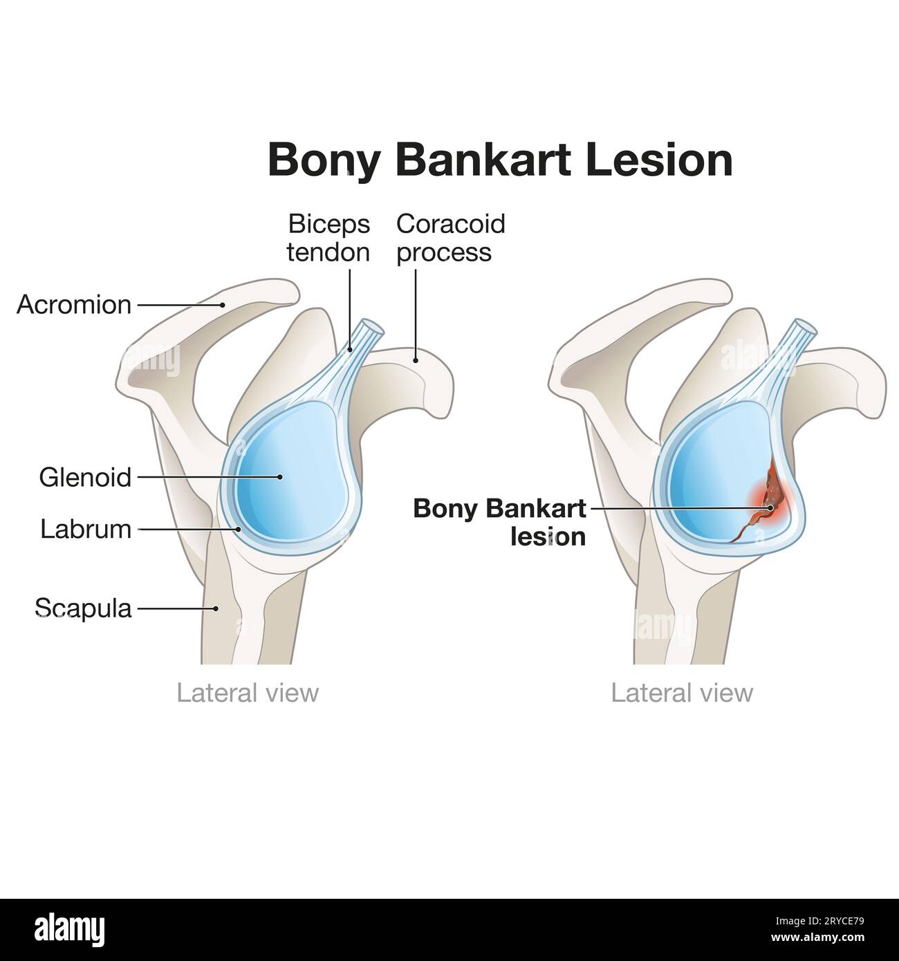 Une lésion osseuse de Bankart dans l'épaule implique une fracture du bord antérieur de la glène, résultant souvent d'une luxation, conduisant à l'instabilité et à RE Banque D'Images