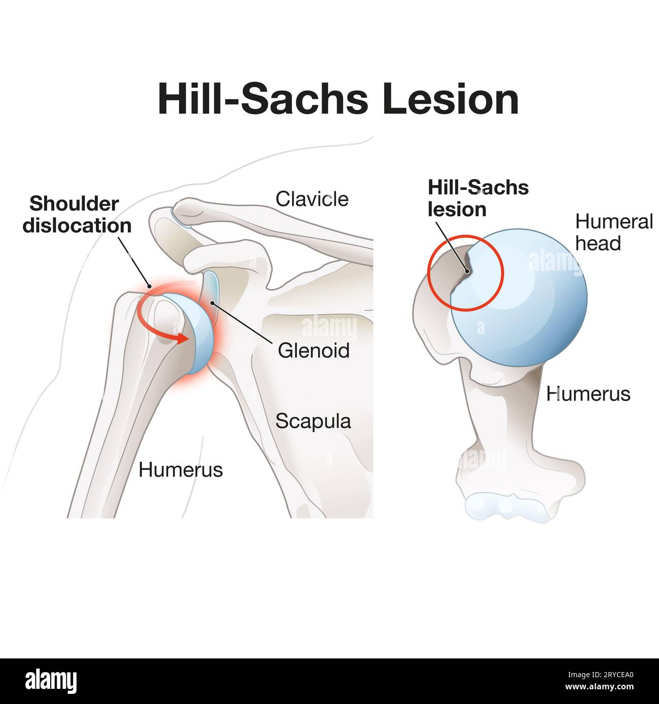 Une lésion de Hill-Sachs est un défaut en forme de divot sur la tête humérale, résultant souvent d'une luxation de l'épaule. Elle peut contribuer à l'instabilité et à la limite Banque D'Images