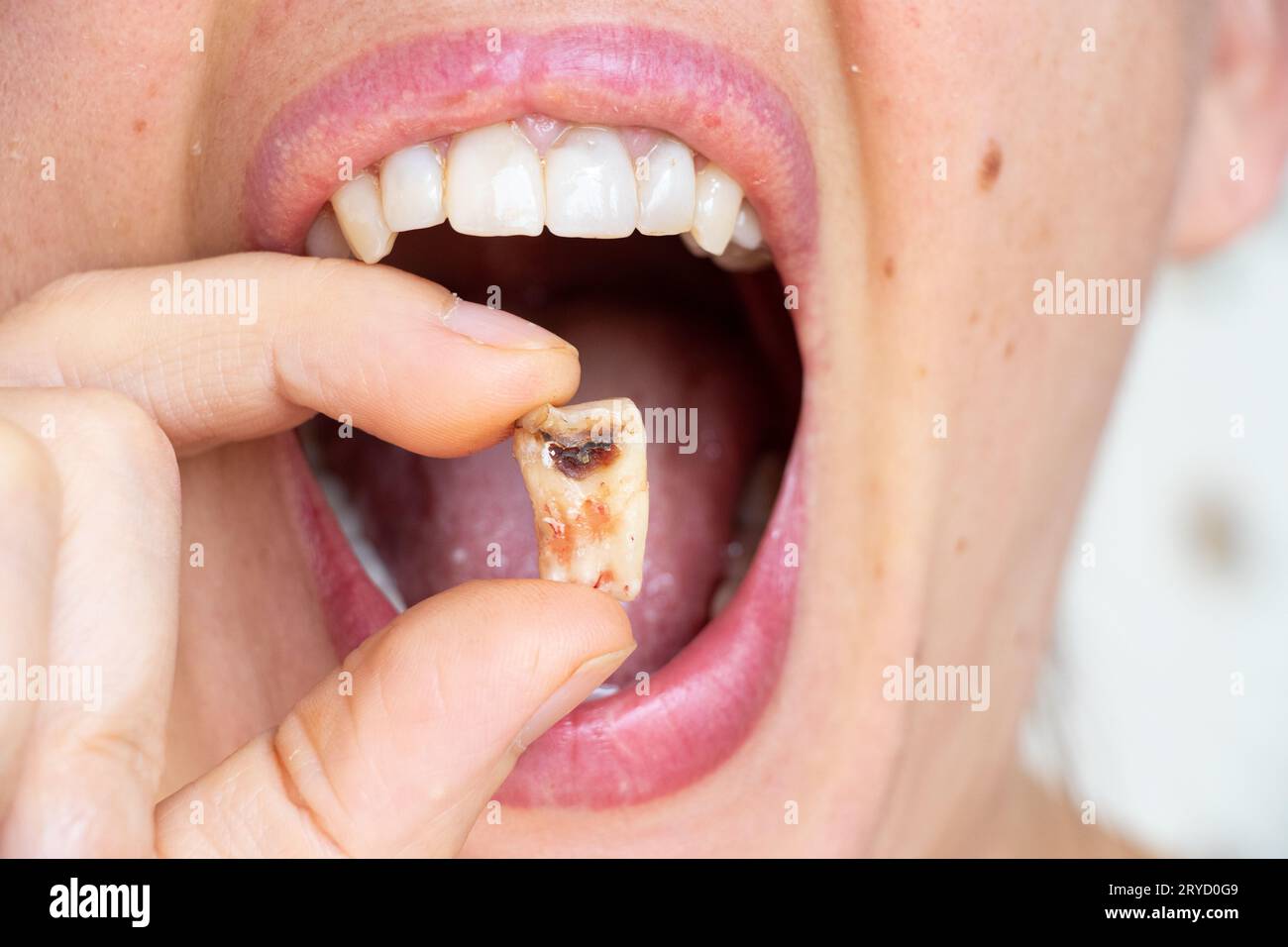 Une fille dans sa main tient une dent arrachée avec un trou noir au milieu de la dent gros plan, une dent malade dans sa main après le retrait qui pourrait n Banque D'Images