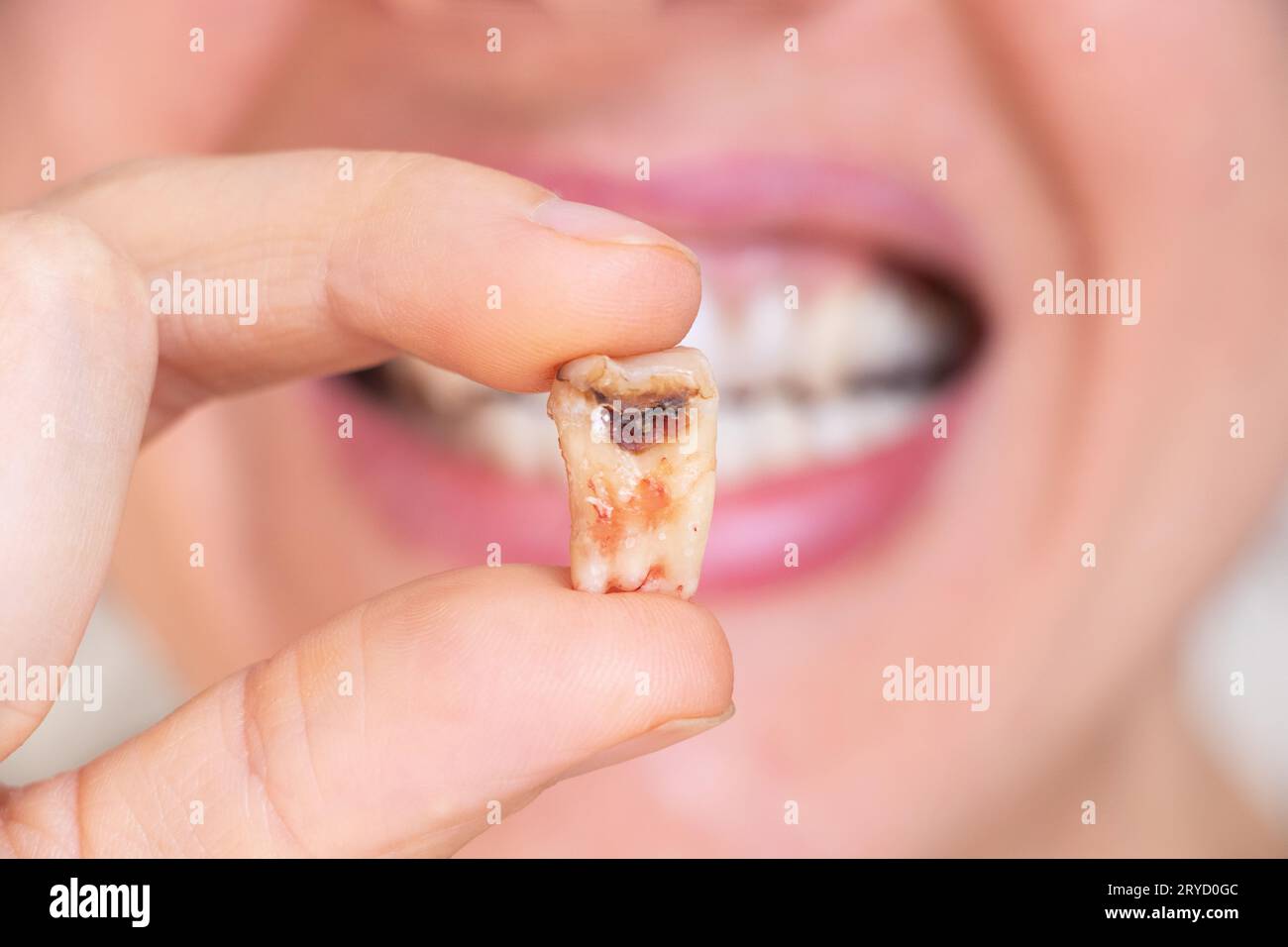 Une fille dans sa main tient une dent arrachée avec un trou noir au milieu de la dent gros plan, une dent malade dans sa main après le retrait qui pourrait n Banque D'Images