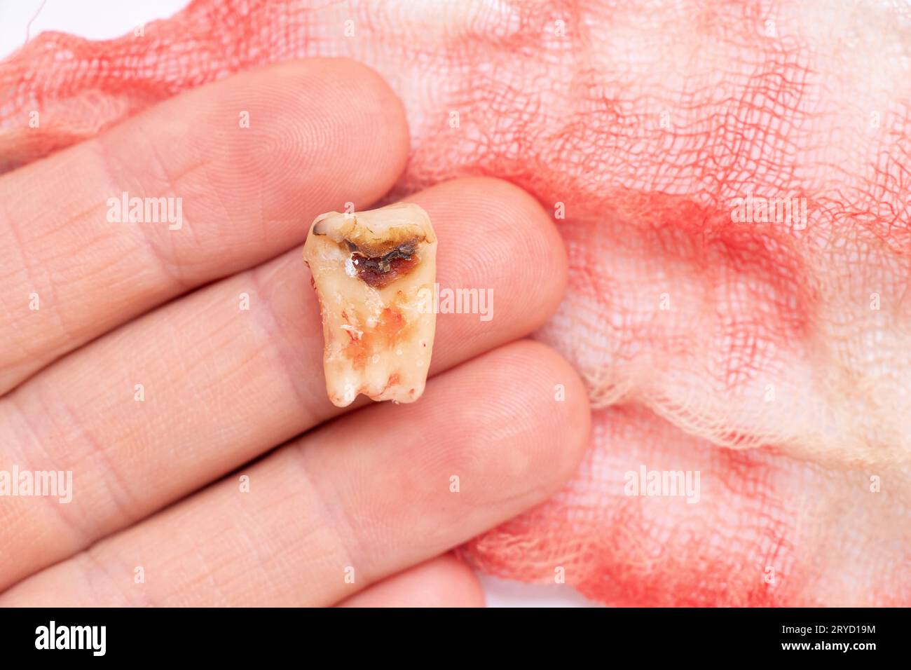 Une fille dans sa main tient une dent extraite avec un trou noir au milieu de la dent, gros plan sur le fond d'un bandage avec du sang, dans Banque D'Images