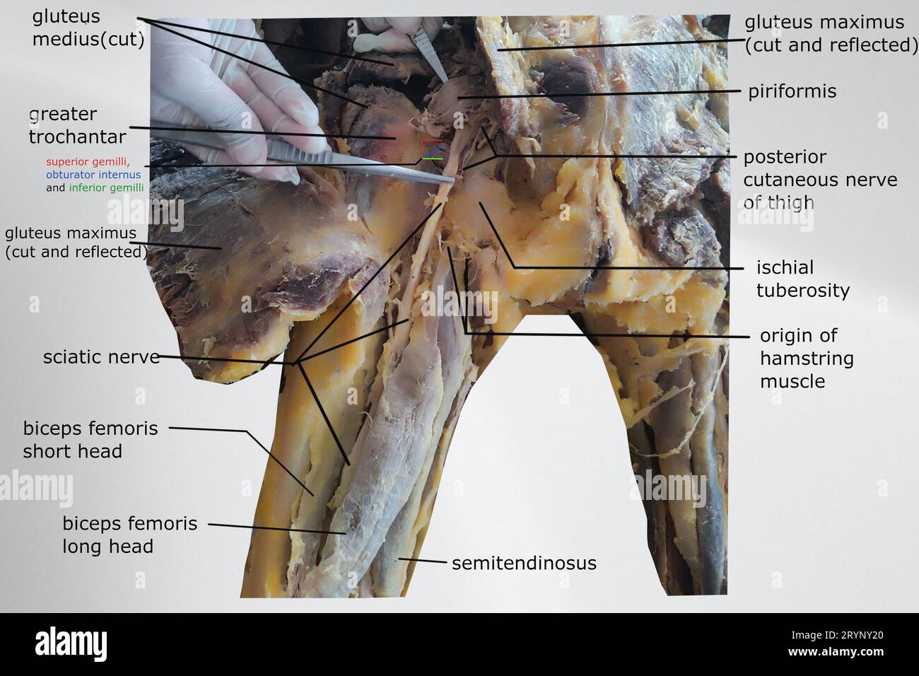 image de dissection de la région fessière montrant l'évolution du nerf sciatique, les muscles ischio-jambiers et le muscle fessier Banque D'Images