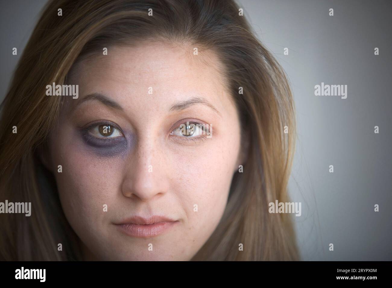 Portrait d'une jeune femme avec un œil noir, regardant la caméra. Banque D'Images