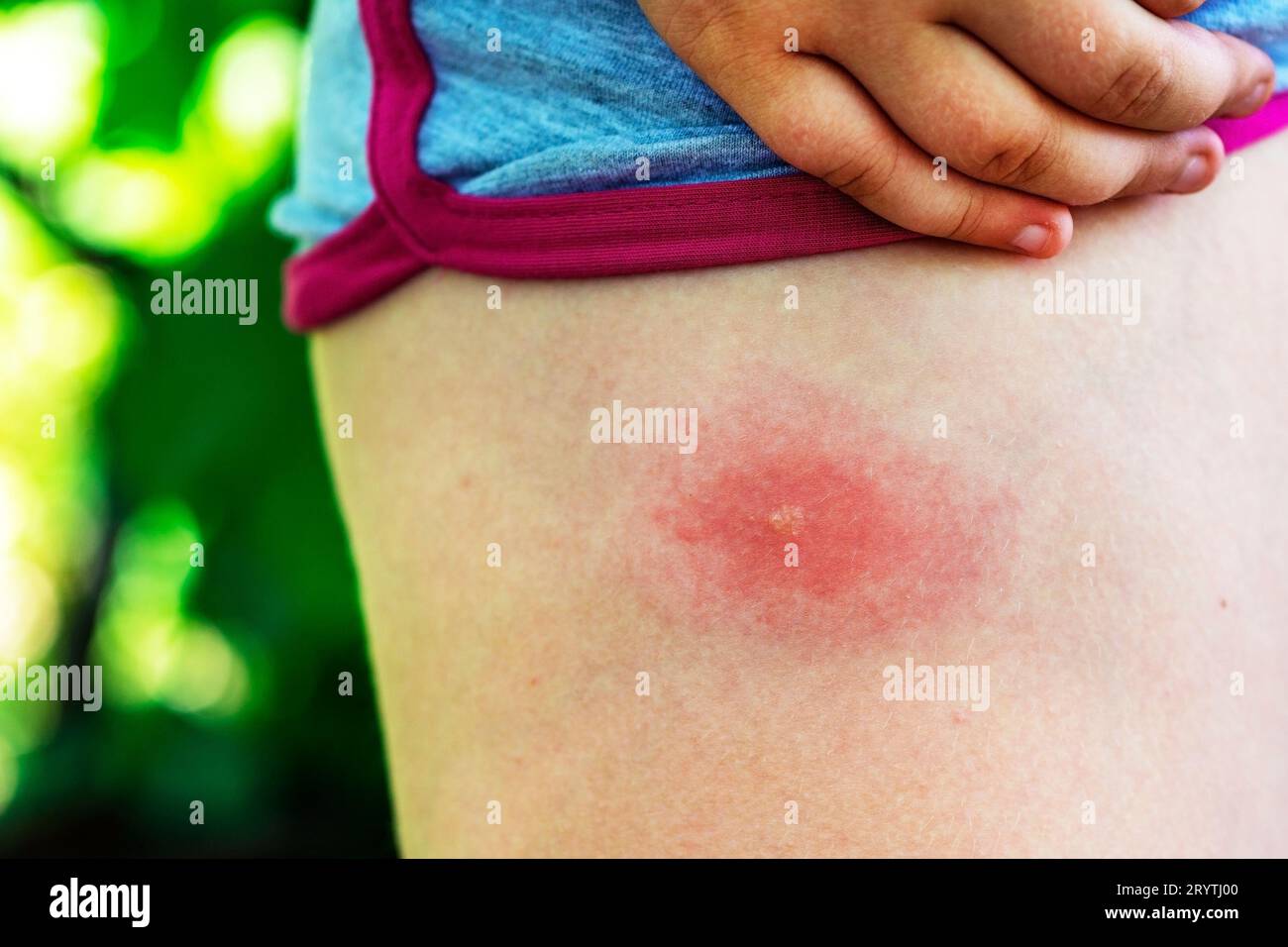 La piqûre de tique sur la jambe, gros plan. Allergie aux piqûres d'insectes. Plaie et conséquences après piqûre de moustique. Peau acnéique. Allergie cutanée Banque D'Images