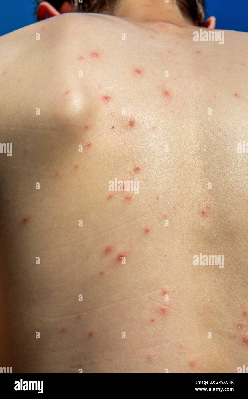 Varicella zoster virus Banque de photographies et d’images à haute