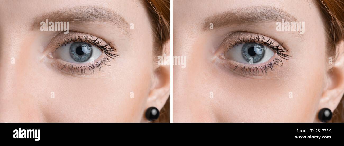 Comparaison d'une jeune femme avec et sans cercle sombre sous l'oeil, gros plan Banque D'Images