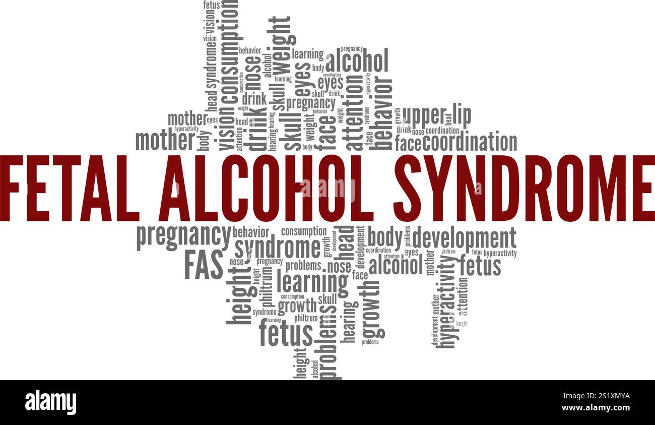 FAS - Fetal Alcohol syndrome Word Cloud conception conceptuelle isolé sur fond blanc. Illustration de Vecteur