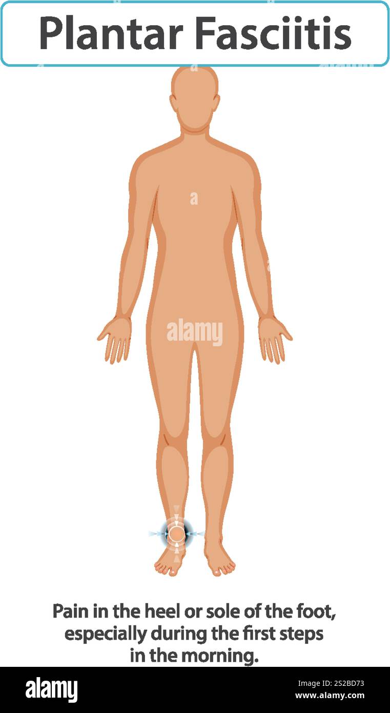 Illustration de la douleur au pied et de ses symptômes communs Illustration de Vecteur