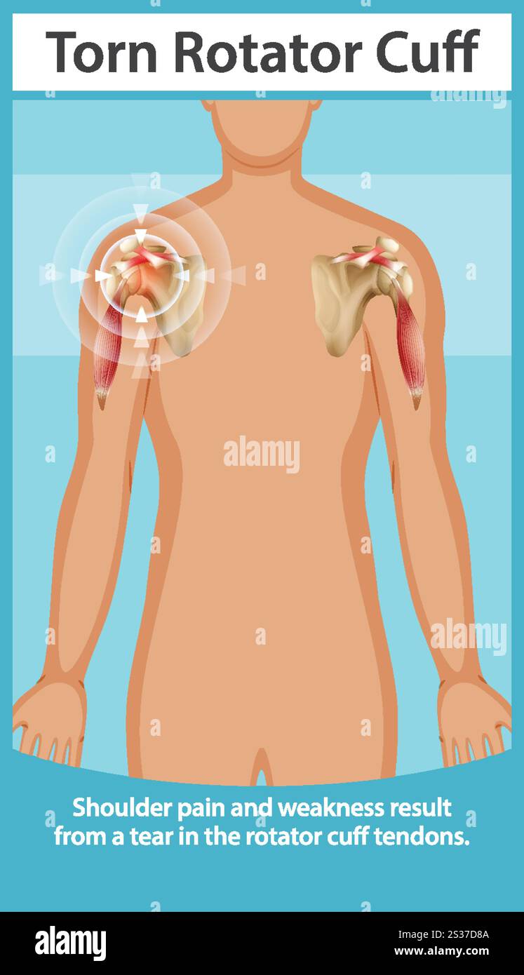 Illustration de l'anatomie de l'épaule et détails de la blessure Illustration de Vecteur