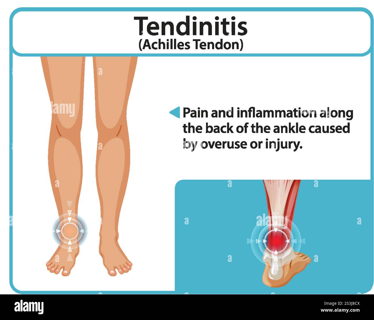 Illustration de douleur et d'inflammation du tendon d'Achille Illustration de Vecteur
