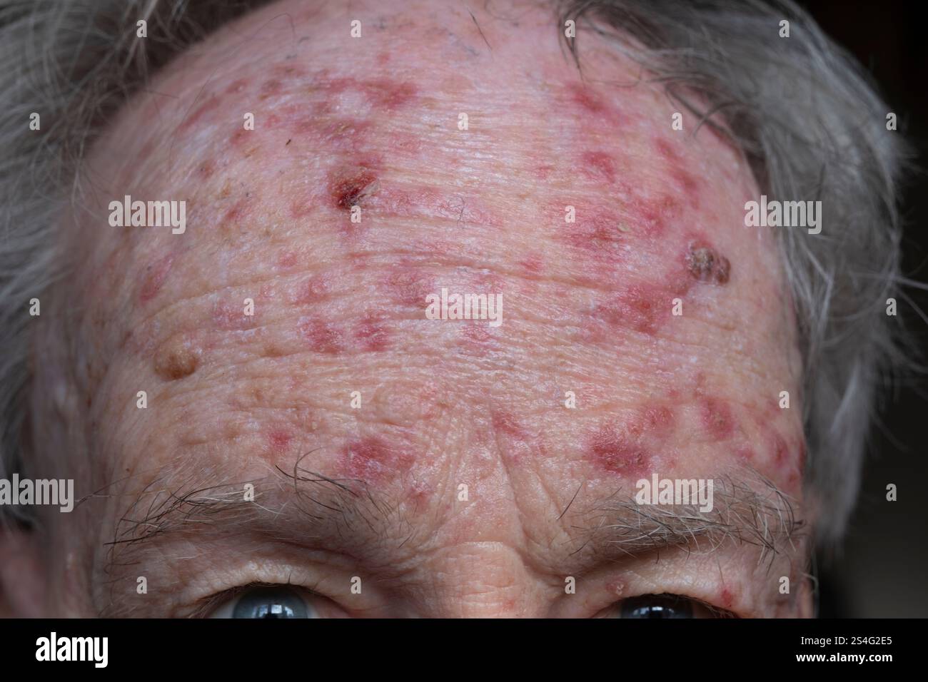Front de l'homme au cours du traitement de la kératose actinique par le flurouracil pommade. Lésions croûteuses rouges de la peau endommagée par le soleil ou des taches solaires Banque D'Images