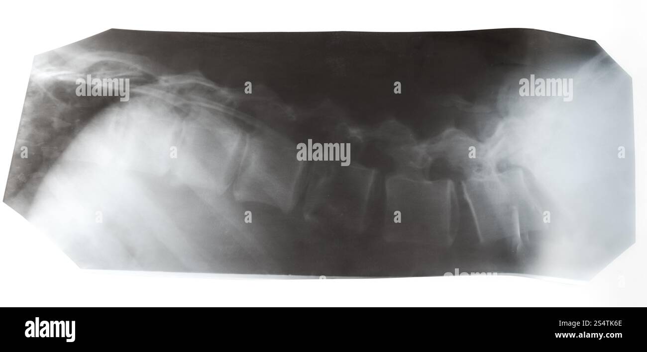Radiographie de la colonne vertébrale humaine isolée sur fond blanc Banque D'Images