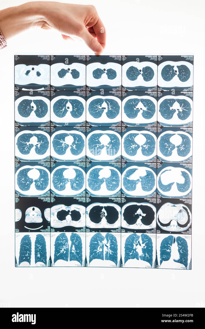 Closeup shot of male hand holding poumons résultats tomographie Banque D'Images