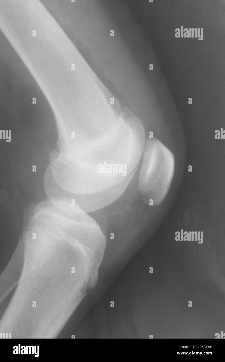 Vue latérale du genou humain avec rotule sur X-ray image Banque D'Images