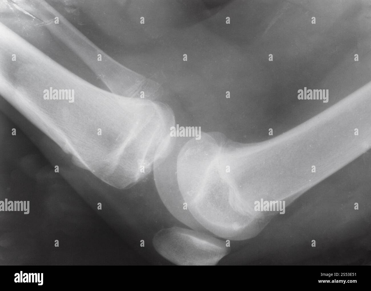Vue latérale de l'articulation du genou avec rotule sur X-ray image Banque D'Images