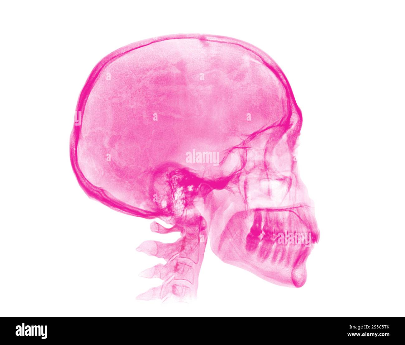 Crâne humain. Image radiographique rose isolée sur fond blanc. Crâne humain. Image de rayons X rose sur fond blanc Banque D'Images