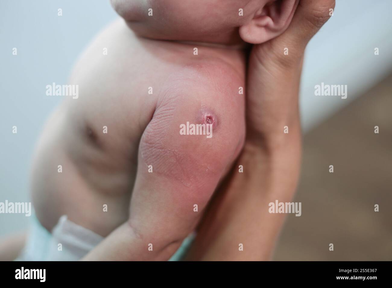 Nouveau-né avec des points rouges dus à l'injection Banque D'Images