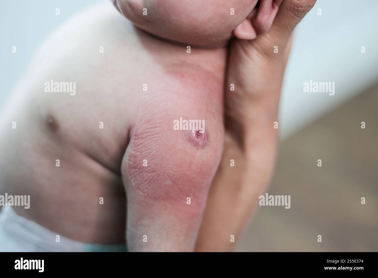 Nouveau-né avec des points rouges dus à l'injection Banque D'Images