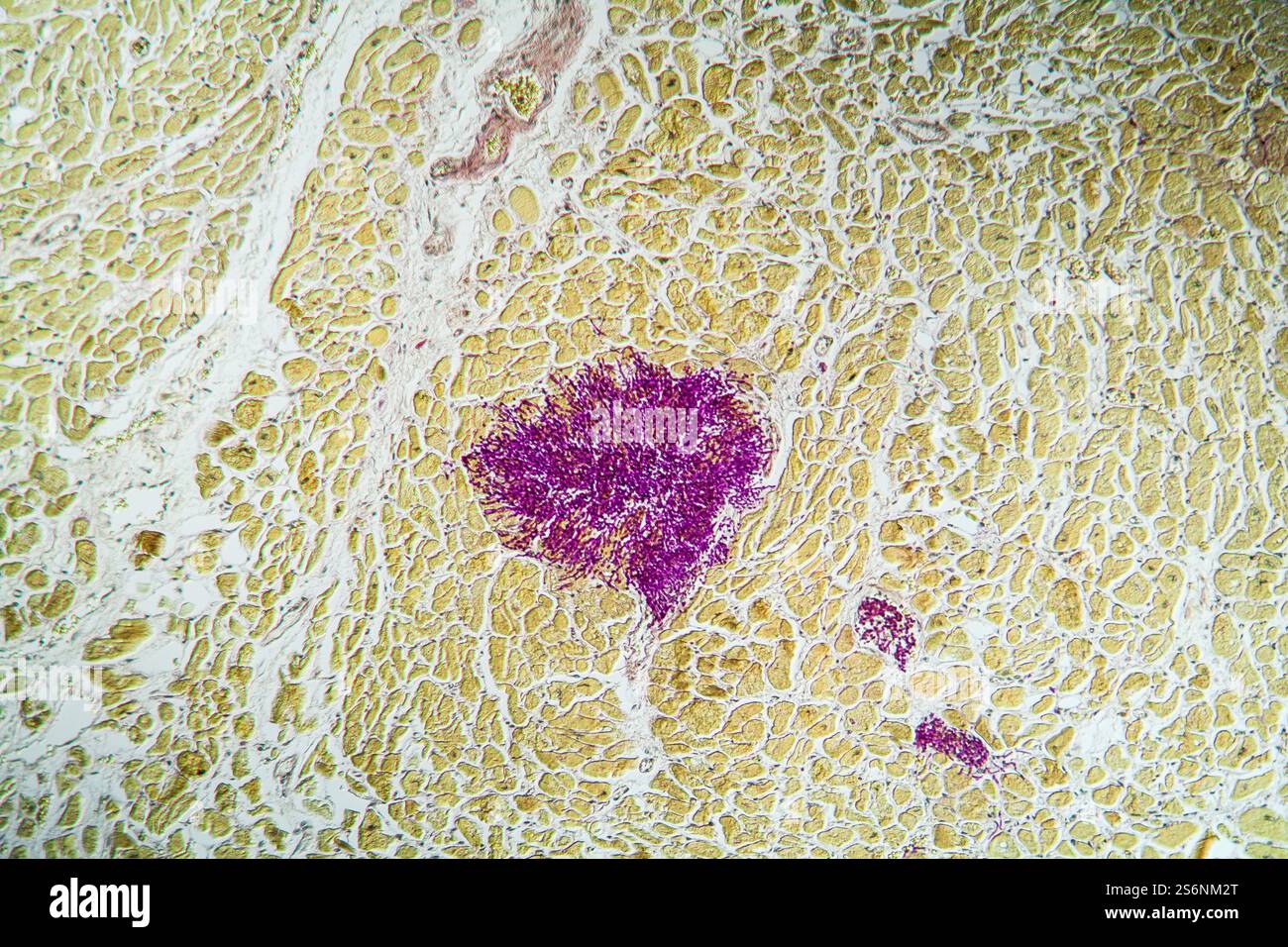 Candida dans le muscle cardiaque d'un malade du SIDA, 100x Banque D'Images