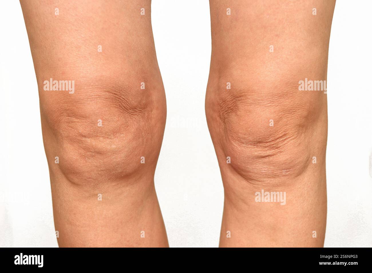 Arthrose du genou Banque D'Images