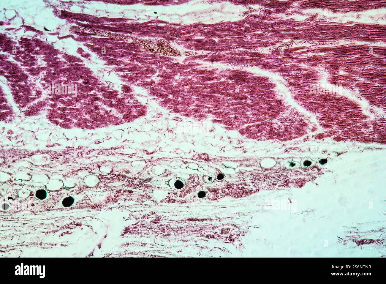 Cancer de la peau affecté tissu 100x Banque D'Images