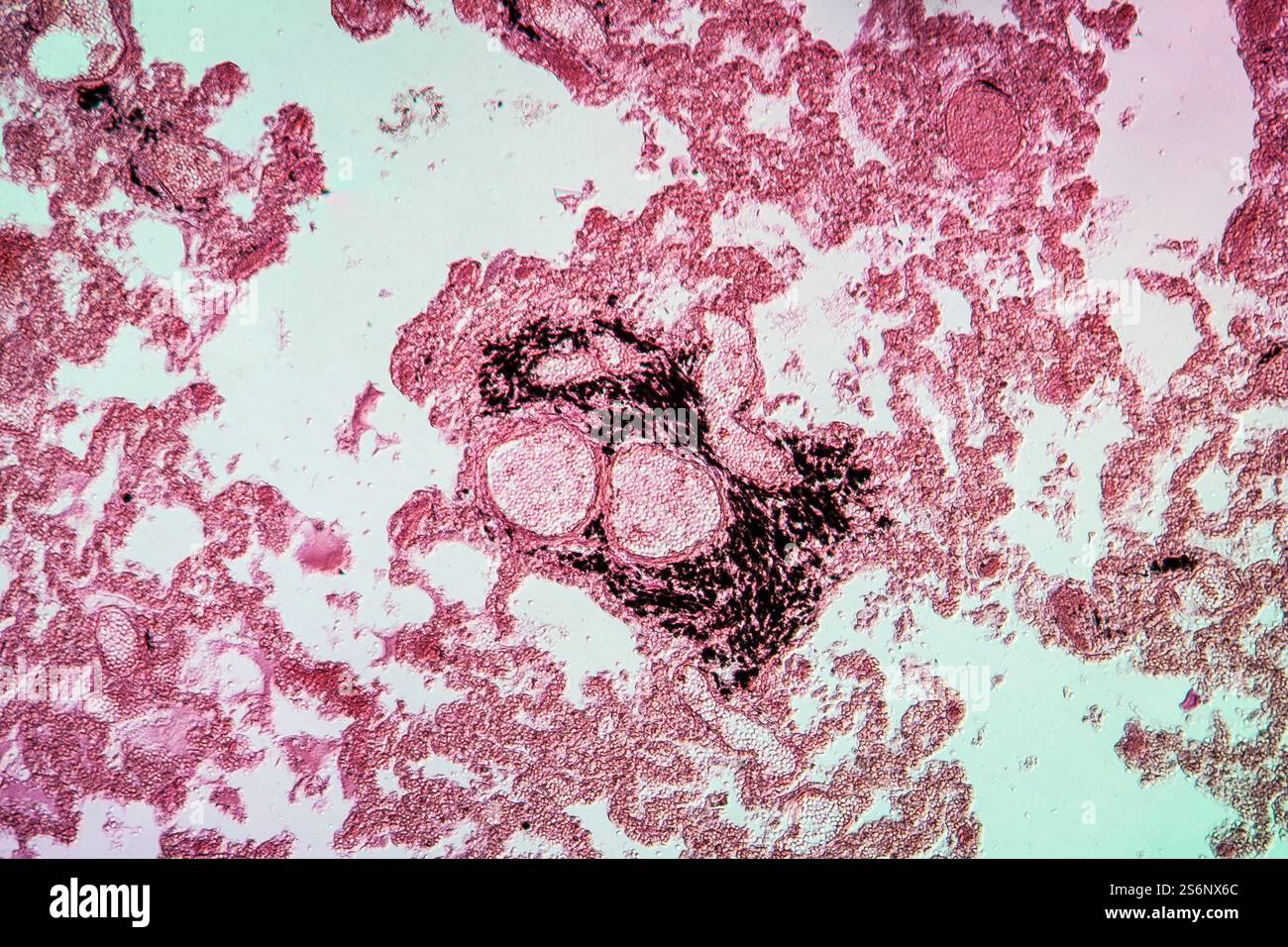 Embolie pulmonaire après fracture des os 100x Banque D'Images