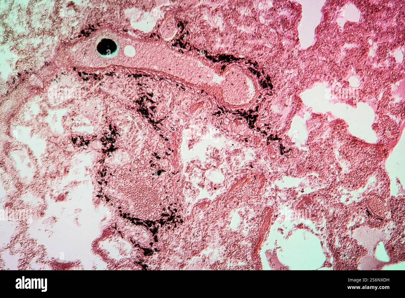 Embolie pulmonaire après fracture des os 100x Banque D'Images