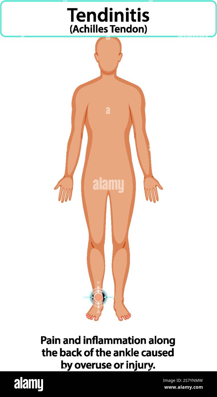 Diagramme montrant la douleur et l'inflammation du tendon d'Achille Illustration de Vecteur