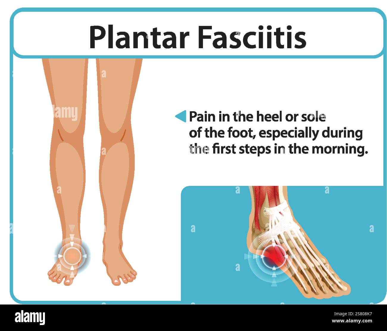 Illustration de douleurs au pied et symptômes de fasciite plantaire Illustration de Vecteur