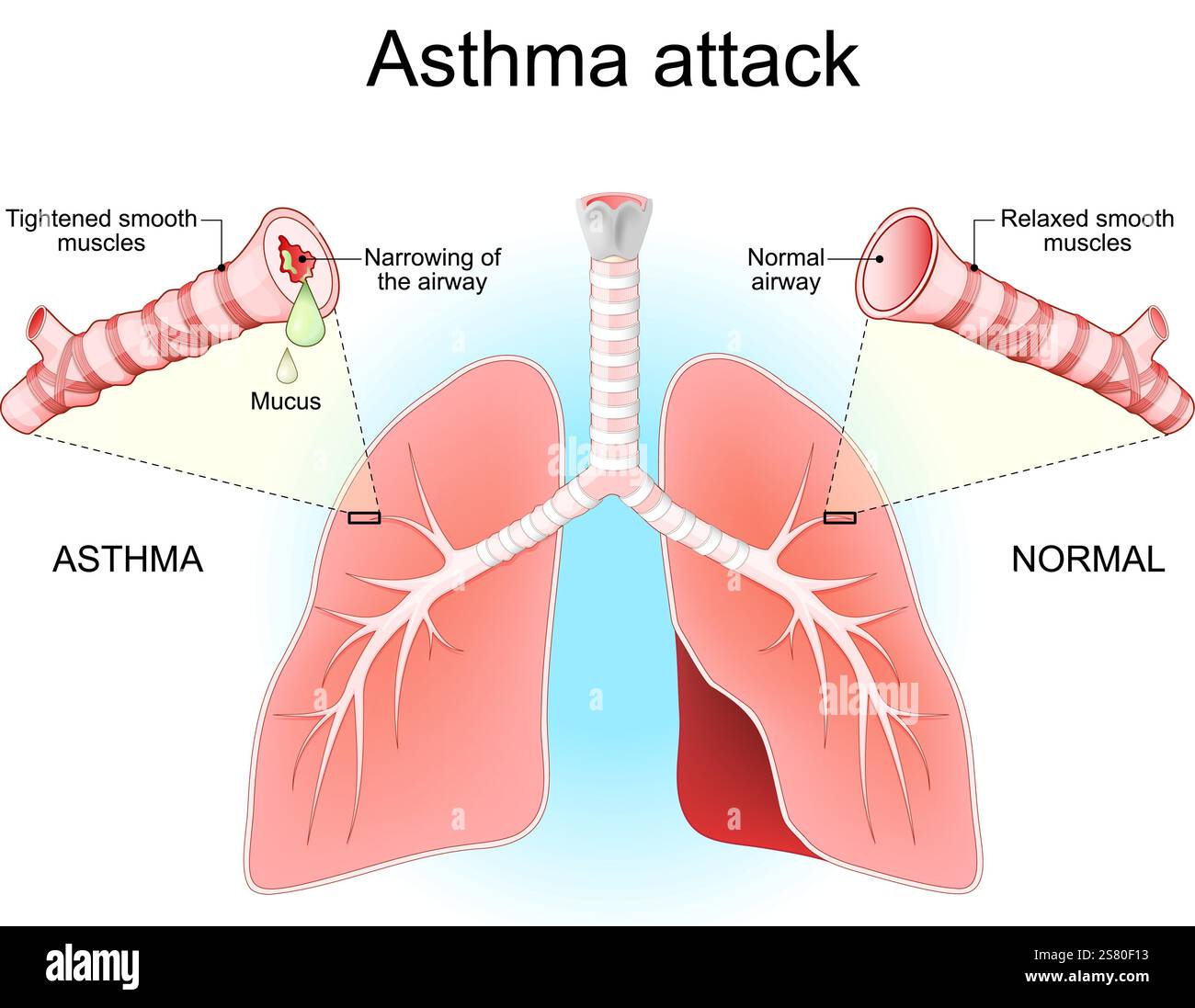 Crise d'asthme. Poumons, bronches et voies respiratoires. Gros plan d'une coupe transversale d'une voie aérienne normale et rétrécie de bronchioles avec mucus. Symptômes de l'asthme Illustration de Vecteur