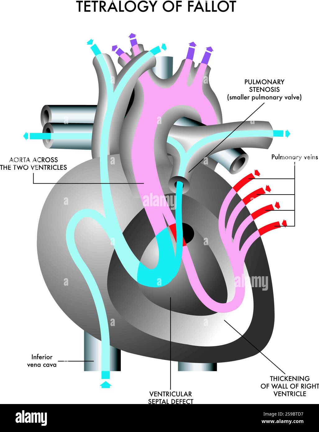 Illustration schématique des symptômes de la tétralogie de Fallot, une malformation cardiaque congénitale, avec annotations. Illustration de Vecteur