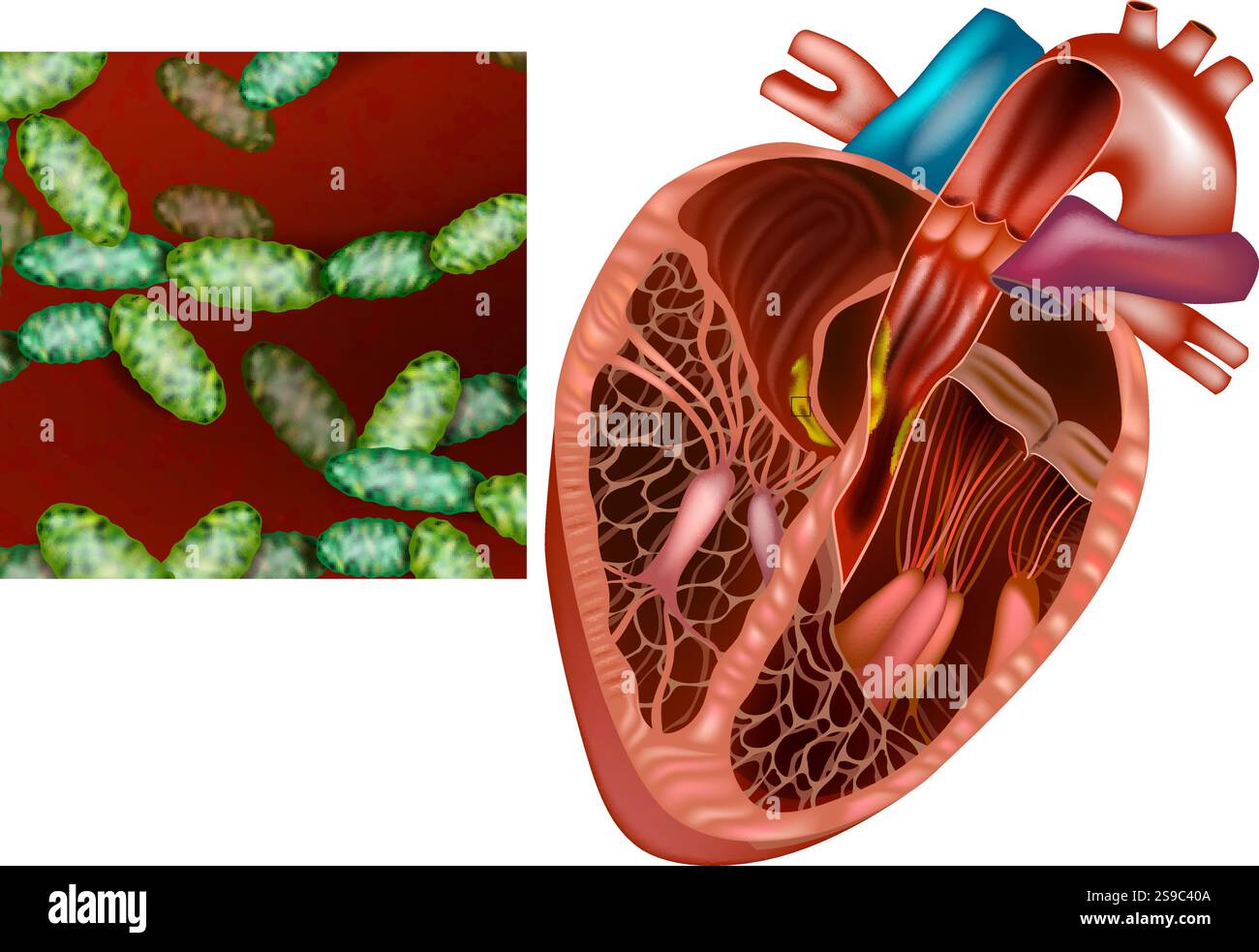 Illustration d'une endocardite bactérienne. Infection cardiaque et bactérie Haemophilus influenzae. Diagramme des bactéries cardiaques et pathogènes. Illustration de Vecteur