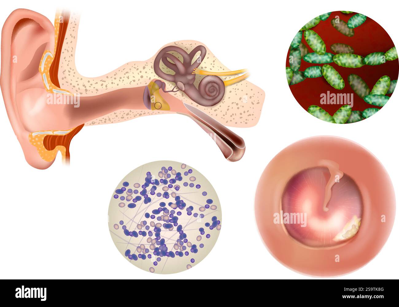 Anatomie et infection de l'oreille moyenne. Otite moyenne aiguë avec bactéries gros plan. Illustration de Vecteur