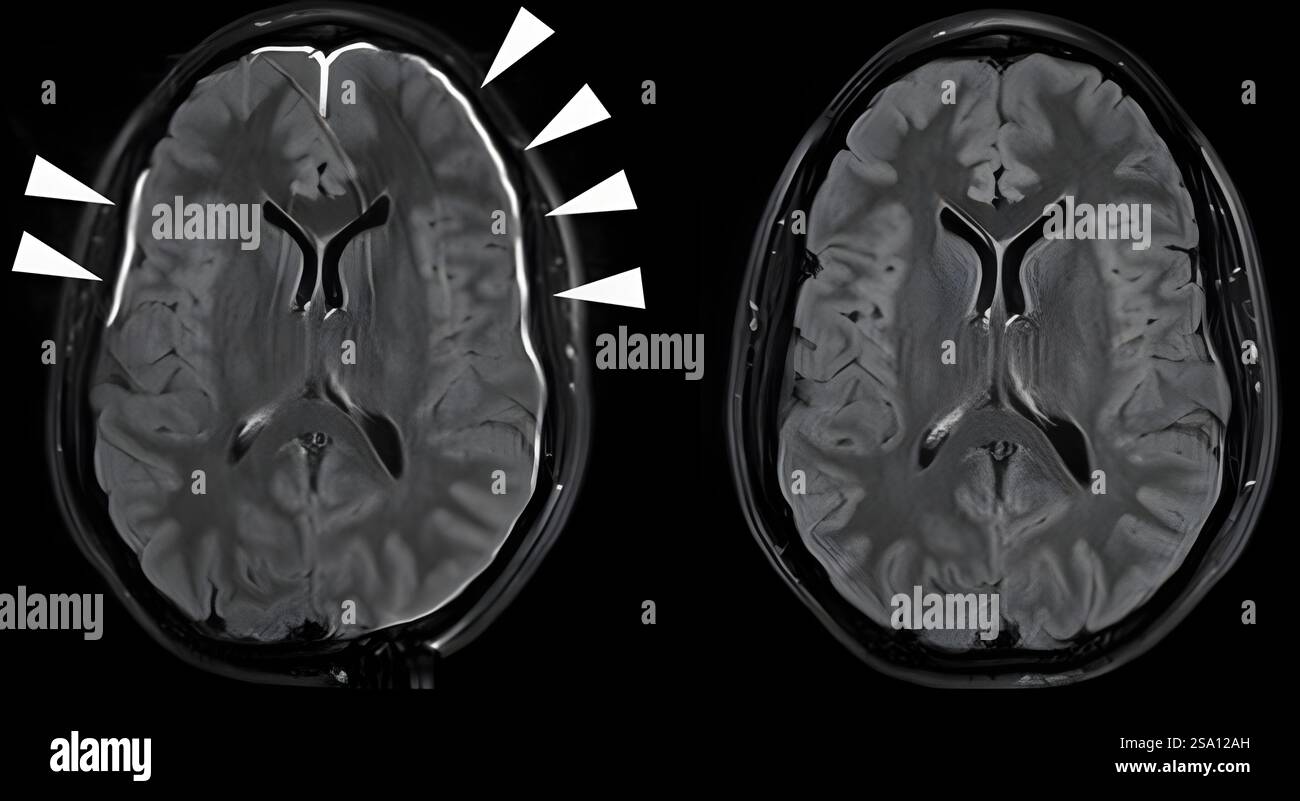 Un jour après un traumatisme crânien (à gauche), un colorant lumineux le long du bord du cerveau suggère des dommages aux méninges, ou à la doublure protectrice du cerveau. Banque D'Images