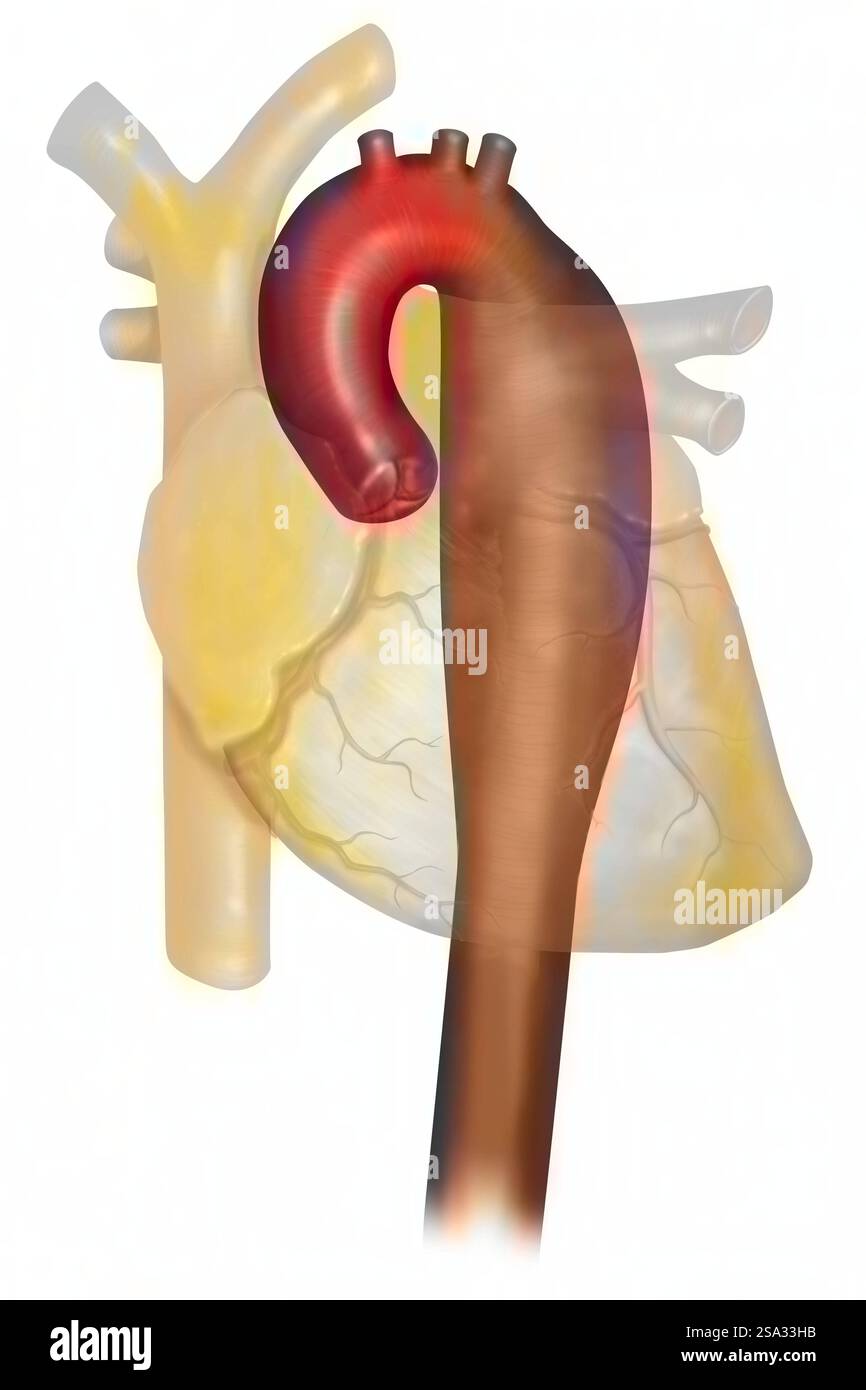 Anévrysme de l'aorte thoracique descendante. Un anévrisme est une dilatation localisée de la paroi d'une poche de sang de vaisseau sanguin, dont la rupture peut Banque D'Images