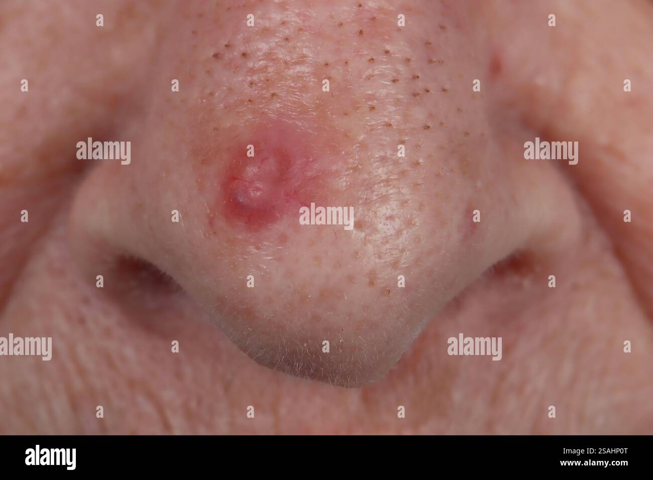 Carcinome basocellulaire du nez chez une femme de 85 ans. Banque D'Images