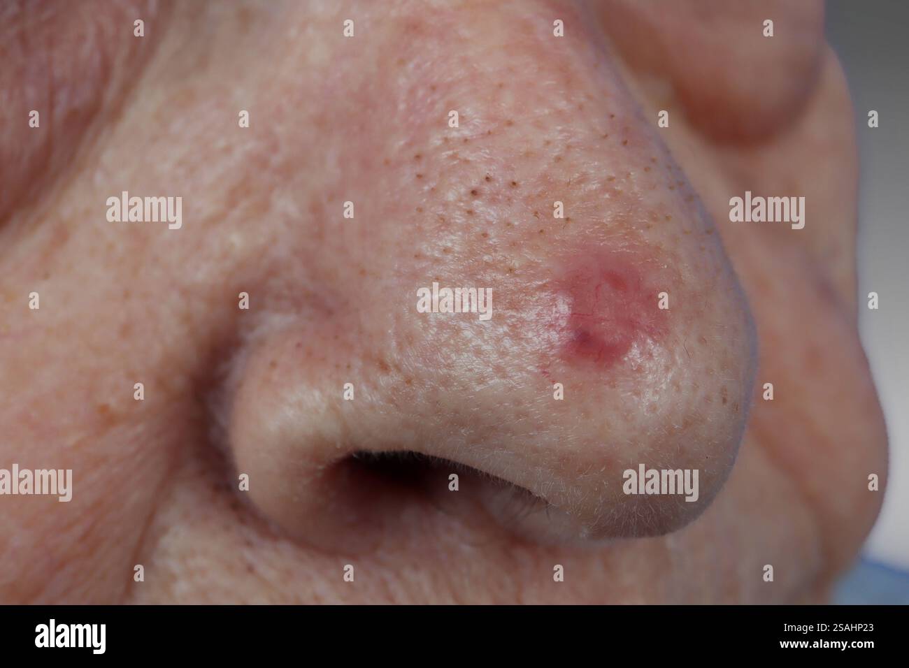 Carcinome basocellulaire du nez chez une femme de 85 ans. Banque D'Images
