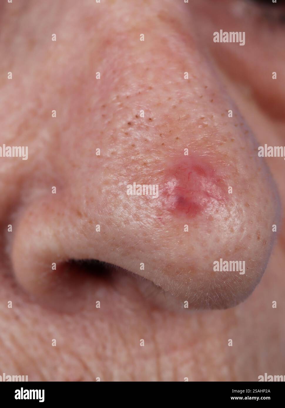 Carcinome basocellulaire du nez chez une femme de 85 ans. Banque D'Images