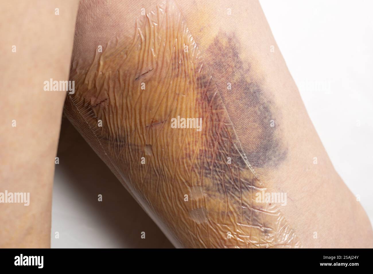Jambes de femme après une chirurgie de varices, avec sutures chirurgicales visibles, points de suture et plaies sur une jambe. Traitement curatif, procédures esthétiques, thromboses Banque D'Images