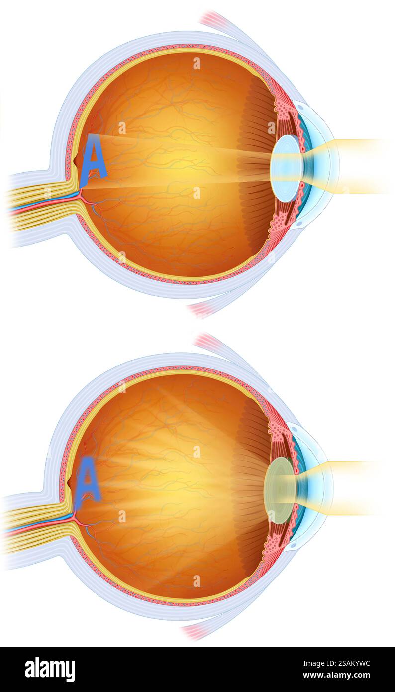 Illustration de deux images du foyer visuel de l'œil. L'une est normale, et l'autre a une cataracte oculaire, opacification progressive du cristallin. Banque D'Images
